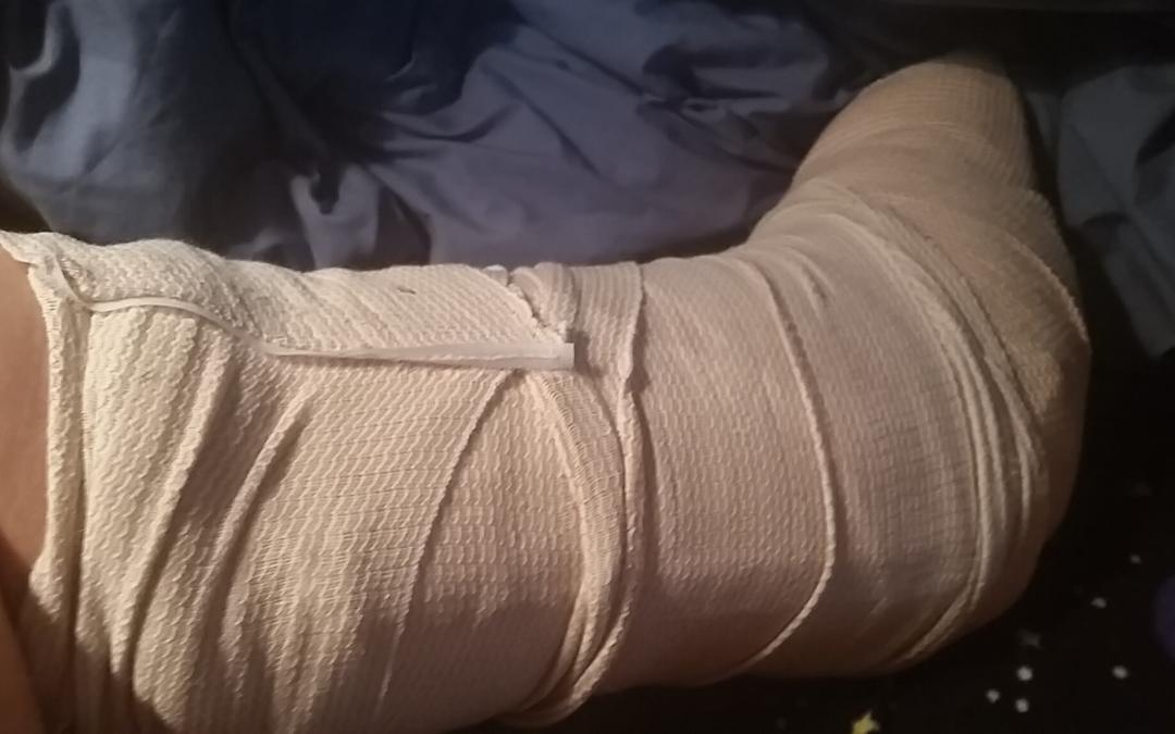 Broken Ankle motivates Life Backup Plan app