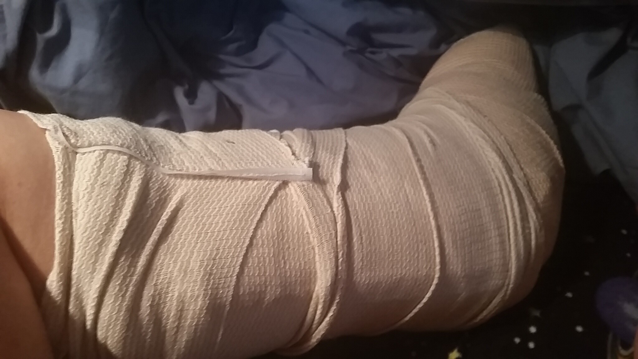 Sandy Eulitt's left ankle wrapped in a "Bulky Joe" following a visit to the UC San Diego emergency room June 5, 2025, after breaking her ankle while out on a nighttime walk. The experience motivated her to integrate fax capability in a future version of Life Backup Plan