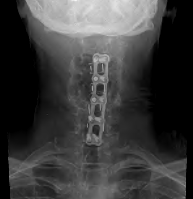 Sandy Eulitt uses Life Backup Plan app for Cervical Spine Surgery Recovery