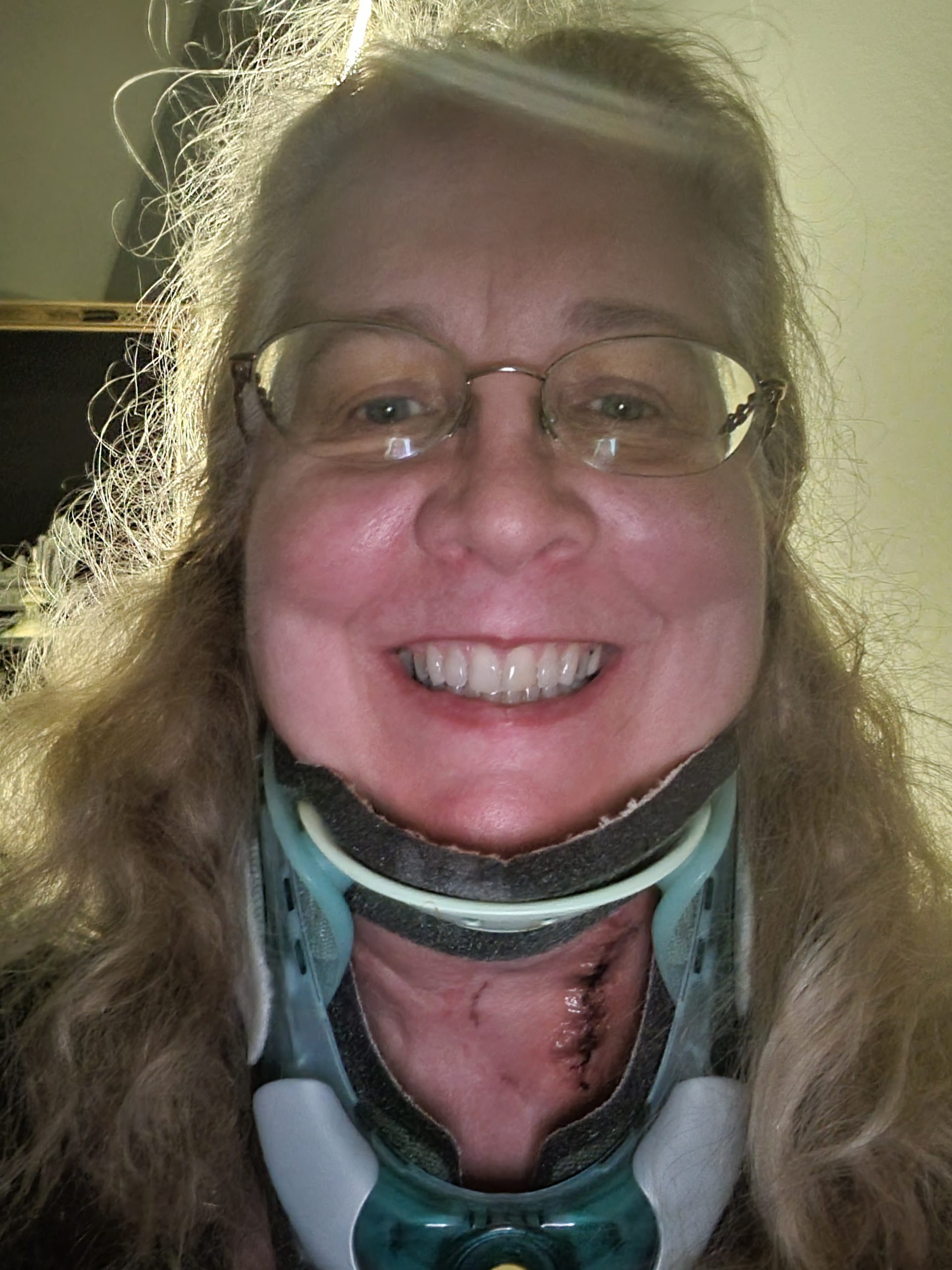 Sandy Eulitt in cervical spine hard collar after first cervical spine surgery, an anterior cervical disectomy and fusion of C3 - C7, with a plate and ten screws, November, 2021